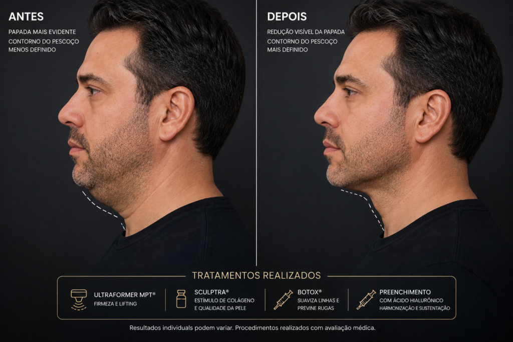 Tratamento para papada sem cirurgia: o que realmente funciona?